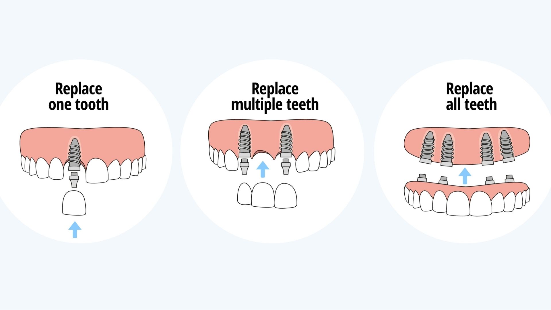 Implant Tedavisi Nedir