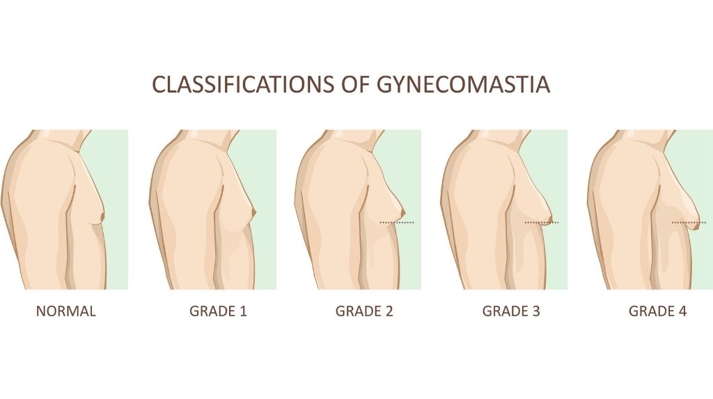 Jinekomasti